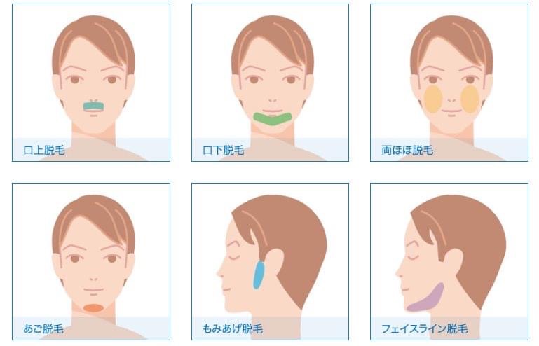 メンズ脱毛サロンラココのヒゲ脱毛コース