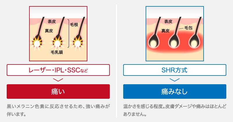 メンズラココはSHR脱毛を採用